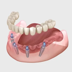 All-On-4 Dental Implants Bromley Treatment Consultations Announced at Smile 4 U Dental Practice